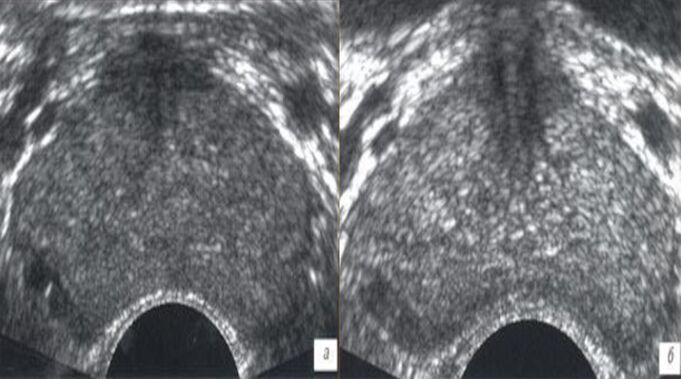 echografie voor en na behandeling met Prostovit-druppels