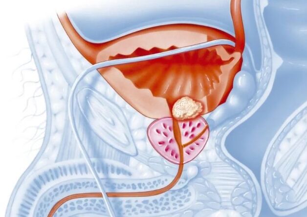Kenmerken van de chronische vorm van prostatitis