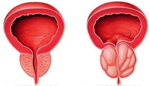 Chronische prostatitis