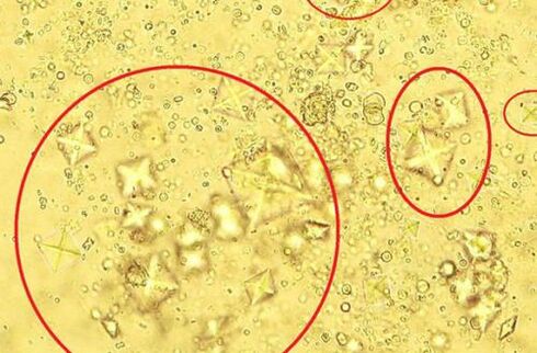 Dit is hoe zoutkristallen in urine met calculous prostatitis er onder een microscoop uitzien